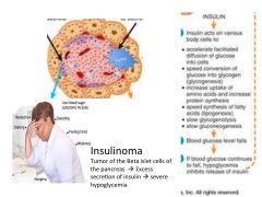a.	Islet cell adenoma that secretes excess insulin
b.	S/Sx: Hypoglycemia, anxiety, & hunger. May be severe: seizures, coma & death
c.	Rare & Benign, usually occur as single small tumors in adults
d.	Assoc /c MEN 1