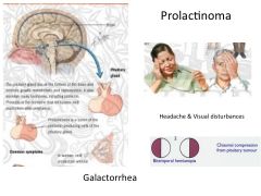 a.	MC is a prolactinoma
b.	Findings: amenorrhea, galactorrhea, low libido, infertility, h/a, 
c.	Can impinge on the optic chiasm → loss of vision (Biotemporal hemianopia or tunnel vision)
d.	Bromocriptine or a dopamine agonist can decrease the size