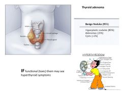 a.	Localized Benign tumor of the thyroid
b.	Derived from follicular epithelium
c.	Usually solitary, well defined, intact capsule (distinguishes it from multinodular goiter)
d.	May be functional (toxic thyroid adenomas) → Secretes large amounts of thyro