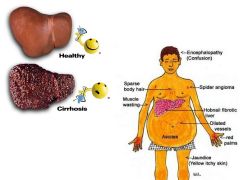 a.	Cirrho ( greek) = tawny yellow
b.	Diffuse fibrosis of liver, destroys normal architecture
c.	Micronodular is < 3mm uniform size dt metabolic insult (e.g., alcohol, hemochromatosis, Wilson’s disease)
d.	Macronodular is > 3mm varied size dt liver inju