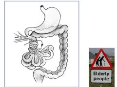a.	Twisting of portion of the bowel around its mesentery
b.	Can lead to obstruction and infarction. 
c.	May occur at cecum & sigmoid colon, where there is redundant mesentery
d.	Usually in elderly