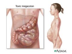 a.	Dilation of the colon that is NOT caused by mechanical obstruction
b.	Often accompanied by paralysis of peristaltic movements of the bowel
c.	Sx: constipation for a long duration, abdominal bloating, tenderness, tympany, pain, palpation of hard fecal