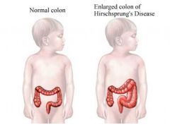 a.	A congenital disorder in which the nerve cells of the myenteric (Auerbach’s plexus) are absent. 
b.	It is rare disorder (1:5000) w/prevalence 4x in males
c.	Autosomal dominant condition and develops in the early stages of pregnancy.