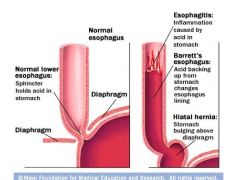 a.	The lining of the esophagus is damaged by stomach acid 
b.	Glandular metaplasia – replacement of nonkeratinized stratified squamous epithelium with intestinal columnar epithelium in the distal esophagus ( lower 1/3) 
c.	Due to chronic acid reflux (GE