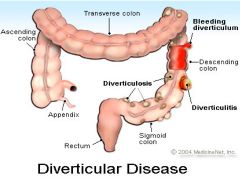 a.	When diverticula (pouches) in the large intestine or colon become inflamed. 
b.	Most occur in the sigmoid colon and become more numerous with age. 
c.	Often benign & asymptomatic, abd pain after meals, hematochezia, N/V, fever, gas, bloating, constip