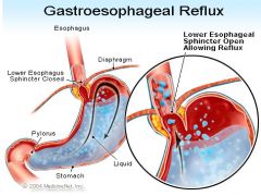 a.	When the stomach contents leak backwards from the stomach into esophagus. Irritating the esophagus and causing heart burn. 
b.	Risk factors: EtOH, hiatal hernia, Obesity, Pregnancy, scleroderma, smoking
c.	Sx: feeling food stuck behind the sternum, h