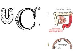 a.	Autoimmune
b.	Hallmarks -C’s : Colon, Continuous, Crypt abcesses, carcinoma, “C”uperficial layers, “C”eudopoylps, colectomy