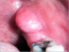 most common lesion of the oral cavity