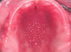 numerous vertical projections each composed of orthokeratotic or parakeratotic squamous epithelium with connective tissue core.