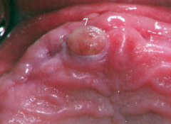 red vascular tissu growing out of a recent extraction site or socket ( may mimic a pyogenic granuloma)