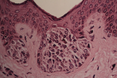 nevus cells are located at the junction of epithelium and CT