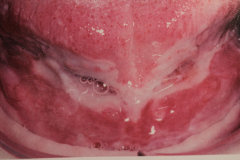 Oral - Often first manifestation (50% of cases)