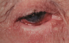 Location - oral mucosa, skin, genetalia, and ocular involvement (25% of the time)