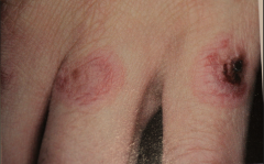 "target" or "Iris" lesion - peripheral gets larger as central area undergoes healing.