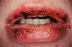 Bloody crusty lips.

No specific treatment - self limiting but may have chronic episodes.