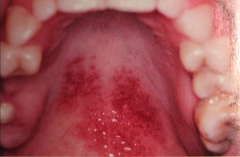 oral lesion in 20% of cases