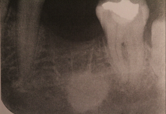 Residual lesion after extraction