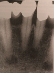 Defining characteristic for this lesion is: Confined to the periapical areas of anterior mandibular teeth.