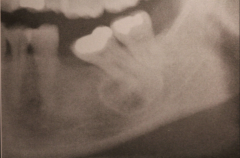 Focal Osseous Dysplasia ( 9 years later after other x-ray)
- always solitary lesion, may occur in any area of the jaws
- posterior mandible is predominant.
- well defined less than 1.5 cm, may have irregular outline
- Lesions vary form pure lucency to