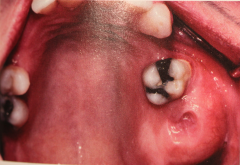 Benign tumor that grows slowly by expansion. may cause displacement of teeth or facial deformity.