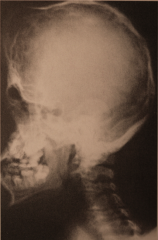 - Acrobrachycephaly (tower skull)