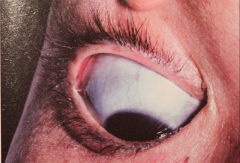 - Possible Blue sclera