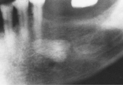 Originally this was mistaken for impacted tooth
- image superimposed on mandible