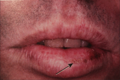 Arrow is pointing to an early SCC that has developed on pt.s lip. Risk due to actinic injury (18-35%)
Notice the red dots