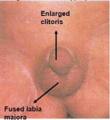 exposure of female fetus to excessive androgens e.g. congenital adrenal hyperplasia -androgens from the adrenal gland