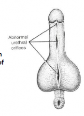 -Abnormal urethral orifices on the ventral surface of penis
-Failure of URETHRAL FOLDS to unite results in abnormal urethral orifices on the ventral surface of penis