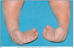 •Talipes equinovarus
•Foot is turned medially and inverted