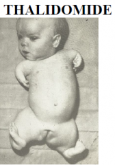 –Partial absence of limbs
–Disturbance of limb development during 5th week
-Inhibits FGFsat the AER
-Thalidomide causes this
-Thalidomide still used as a sedative and antinauseant.
