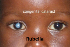 Lens appears white and opaque at birth.
Maternal rubella infections cause this anomaly.