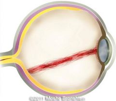 Sometimes remnants of the hyaloid canal or artery can be seen as floats which may interfere with vision.