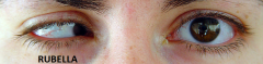 Small eye due to arrested development. May be caused by rubella infection.