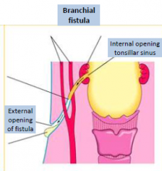 Persistence of the second pharyngeal groove and second pouch, causing a canal between the tonsillar sinus and the outside neck