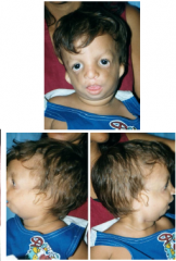 -A First arch syndrome
Failure of neural crest migration into the first arch
Micrognathia
~50% cleft palate
Underdeveloped zygoma
Conductive hearing loss
Malformed pinna
“Drooping” lateral part of lower eyelid
