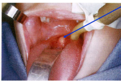Failure of closure of the proximal part of the thyroglossal duct