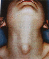 -Cystic remnant of the thyroglossal duct, may open to the exterior
-Usually in the midline, 50% close to the hyoid bone