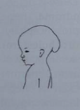 •Defect in the formation of cranial vault usually in the midline
•Often in the occipital bone including foramen magnum but can occur in the frontal and nasal bones
•Approximately 1 in 2000 births