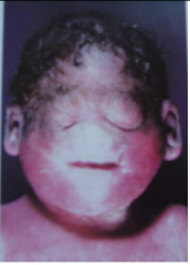 Absent nose (associated with Holoprosencephaly)