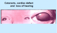 Cataracts, cardiac defect and loss of hearing