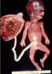 •Birth defects (high risk)
•Miscarriage
•Premature birth
•Neonatal death