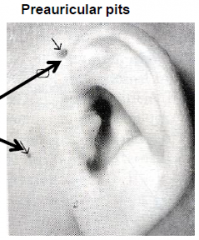 Common and nonpathological. May indicate other anomalies.
Etiology: Remnants of the 1st pharyngeal grooves.