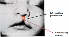 Failure of fusion of left maxillary prominence with the intermaxillary segment [medial nasal prominences