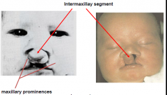 Failure of both maxillary prominences to fuse with the intermaxillay segment
