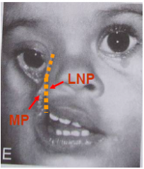 -Failure of maxillary prominence to fuse with lateral nasal process
-Nasolacrimal duct is visible.