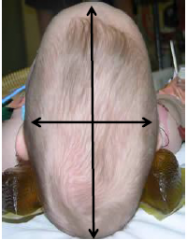 -Elongated and wedge-shaped cranium
-Occurs when SAGITTAL SUTURE closes early