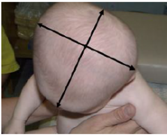 -High, tower-like cranium
-Occurs when CORONAL SUTURE ON BOTH SIDES closes early