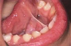 Tongue tied.  

Is caused by an unusually short, thick lingual frenulum.